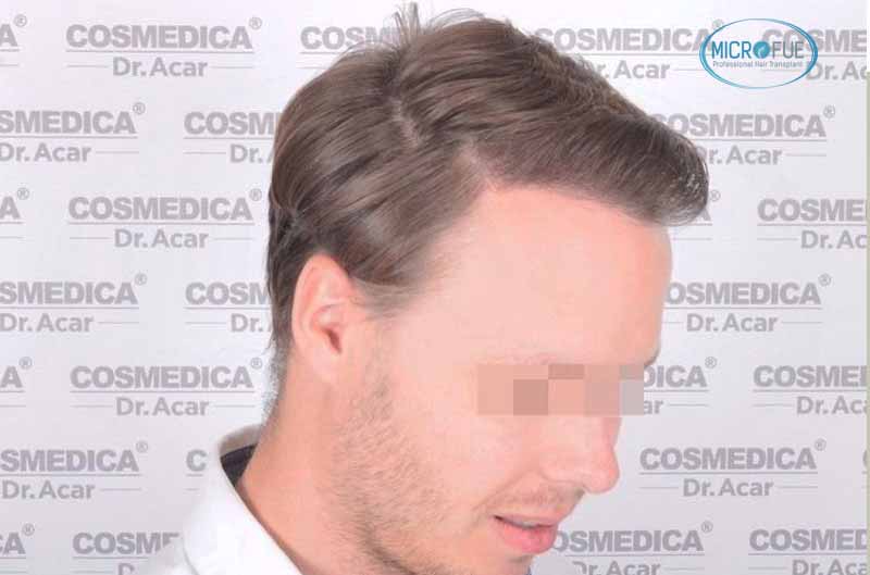 resultado_trasplante_pleo_capilar_Turquia_FUE_Microfue_15 resultado_trasplante_pleo_capilar_Turquia_FUE_Microfue_15