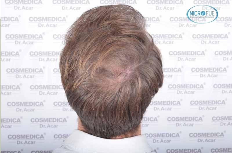 resultado_trasplante_pleo_capilar_Turquia_FUE_Microfue_16 resultado_trasplante_pleo_capilar_Turquia_FUE_Microfue_16