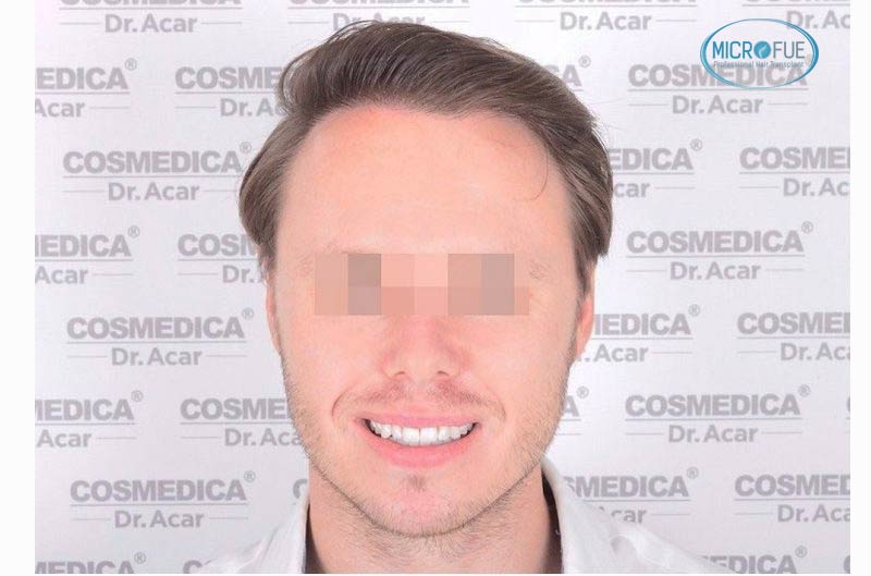resultado_trasplante_pleo_capilar_Turquia_FUE_Microfue_21 resultado_trasplante_pleo_capilar_Turquia_FUE_Microfue_21