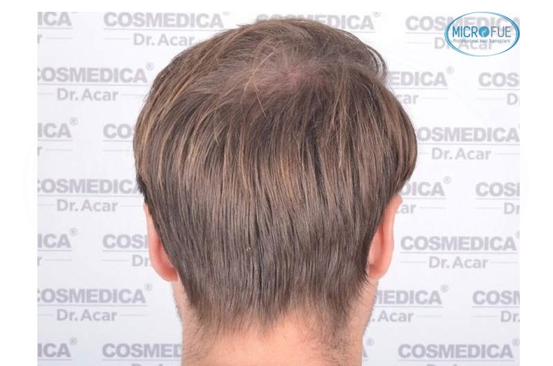 resultado_trasplante_pleo_capilar_Turquia_FUE_Microfue_22 resultado_trasplante_pleo_capilar_Turquia_FUE_Microfue_22