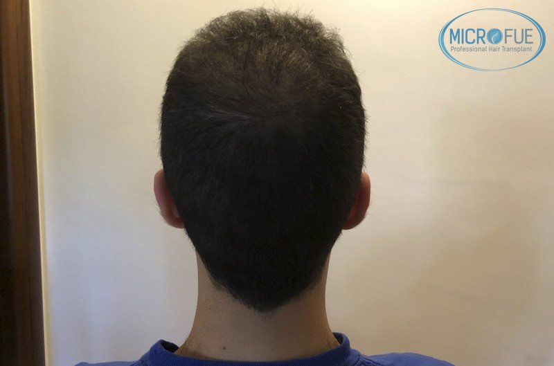 resultados_trasplante_capilar_Turquia_FUE_Microfue_04 resultados_trasplante_capilar_Turquia_FUE_Microfue_04