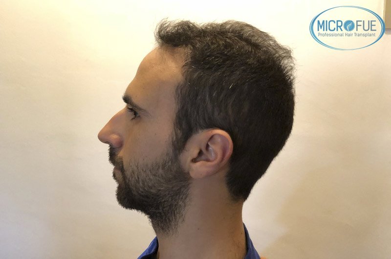 resultados_trasplante_capilar_Turquia_FUE_Microfue_05 resultados_trasplante_capilar_Turquia_FUE_Microfue_05