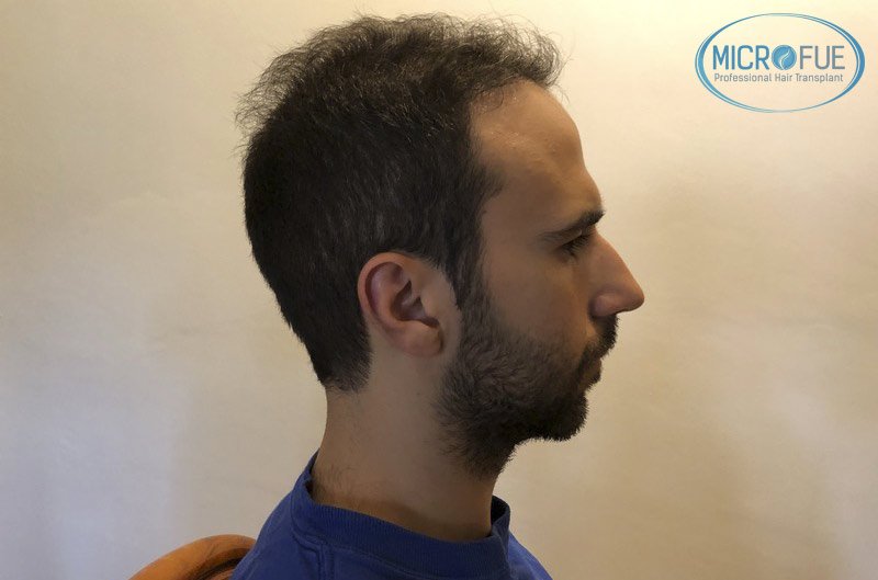 resultados_trasplante_capilar_Turquia_FUE_Microfue_06 resultados_trasplante_capilar_Turquia_FUE_Microfue_06
