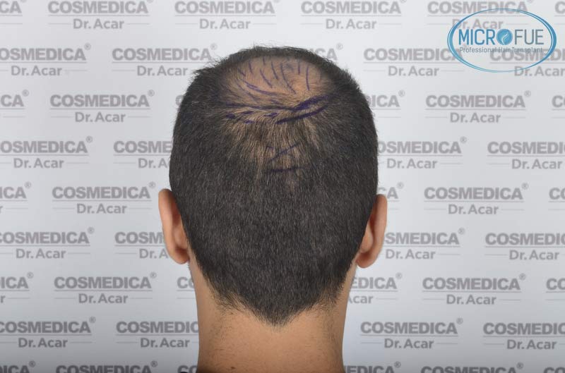 resultados_trasplante_capilar_Turquia_FUE_Microfue_13 resultados_trasplante_capilar_Turquia_FUE_Microfue_13
