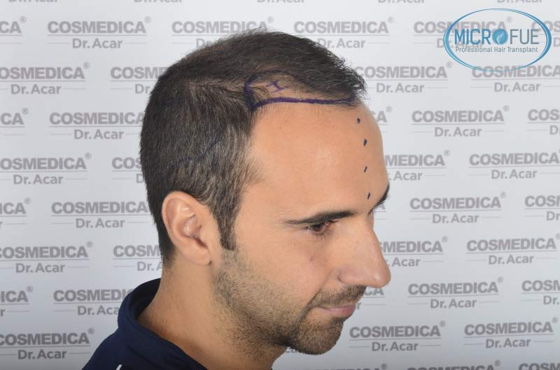 resultados_trasplante_capilar_Turquia_FUE_Microfue_14 resultados_trasplante_capilar_Turquia_FUE_Microfue_14