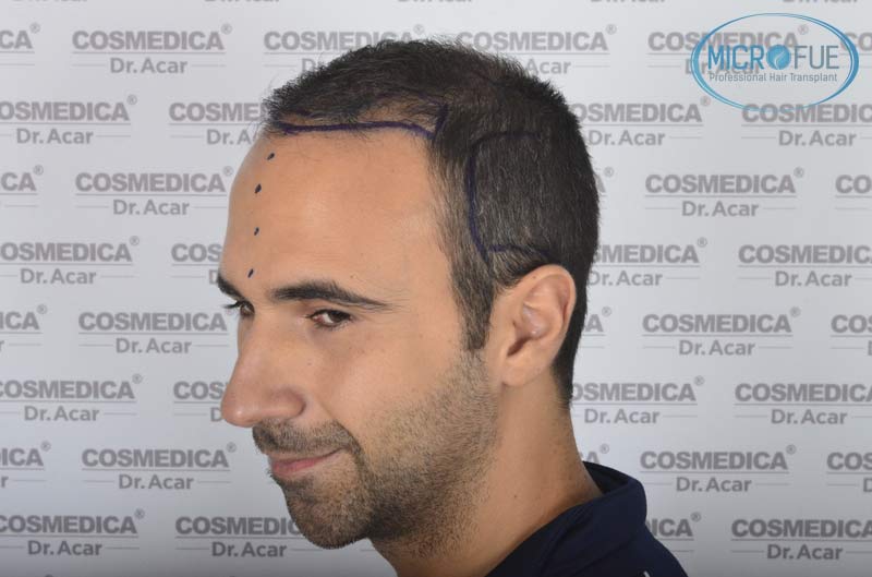 resultados_trasplante_capilar_Turquia_FUE_Microfue_17 resultados_trasplante_capilar_Turquia_FUE_Microfue_17