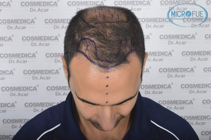 resultados_trasplante_capilar_Turquia_FUE_Microfue_19 resultados_trasplante_capilar_Turquia_FUE_Microfue_19
