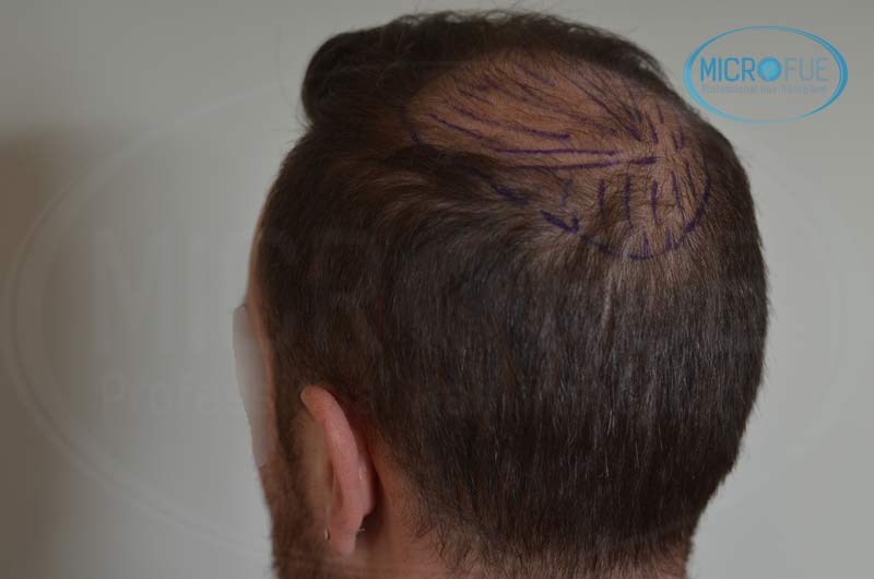 segundo_trasplante_injerto_capilar_Turquia_Microfue_13 segundo_trasplante_injerto_capilar_Turquia_Microfue_13