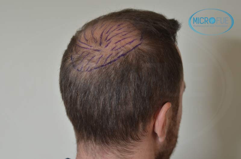 segundo_trasplante_injerto_capilar_Turquia_Microfue_14 segundo_trasplante_injerto_capilar_Turquia_Microfue_14