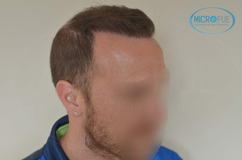 segundo_trasplante_injerto_capilar_Turquia_Microfue_18 segundo_trasplante_injerto_capilar_Turquia_Microfue_18