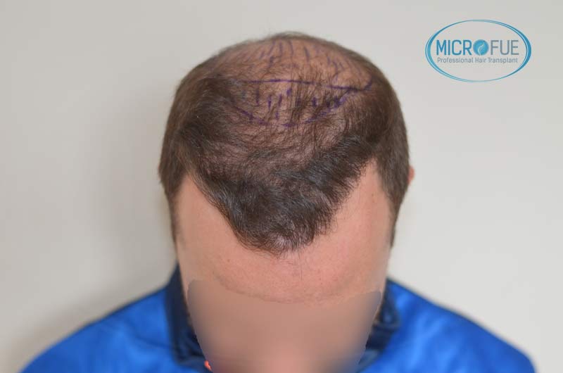 segundo_trasplante_injerto_capilar_Turquia_Microfue_19 segundo_trasplante_injerto_capilar_Turquia_Microfue_19