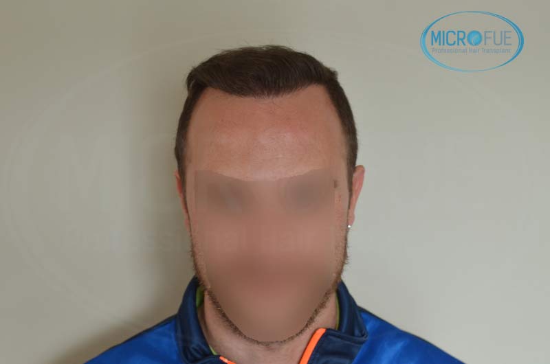 segundo_trasplante_injerto_capilar_Turquia_Microfue_20 segundo_trasplante_injerto_capilar_Turquia_Microfue_20