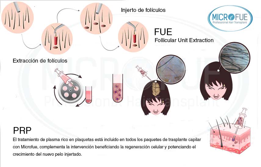 trasplante_capilar_Turquia_tratamiento_plasma_rico_en_plaquetas_Microfue trasplante capilar método Fue tratamiento rico en plaquetas PRP Microfue
