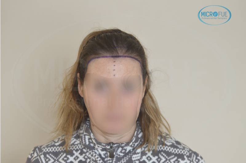 trasplante capilar femenino tecnica FUE Turquia Microfue 07 trasplante capilar femenino tecnica FUE Turquia Microfue 07
