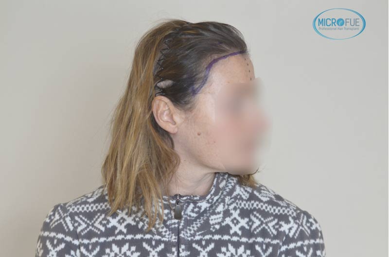trasplante_capilar_femenino_tecnica_FUE_Turquia_Microfue_09 trasplante_capilar_femenino_tecnica_FUE_Turquia_Microfue_09