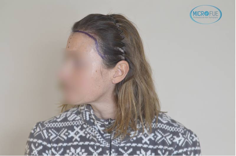 trasplante_capilar_femenino_tecnica_FUE_Turquia_Microfue_10 trasplante_capilar_femenino_tecnica_FUE_Turquia_Microfue_10
