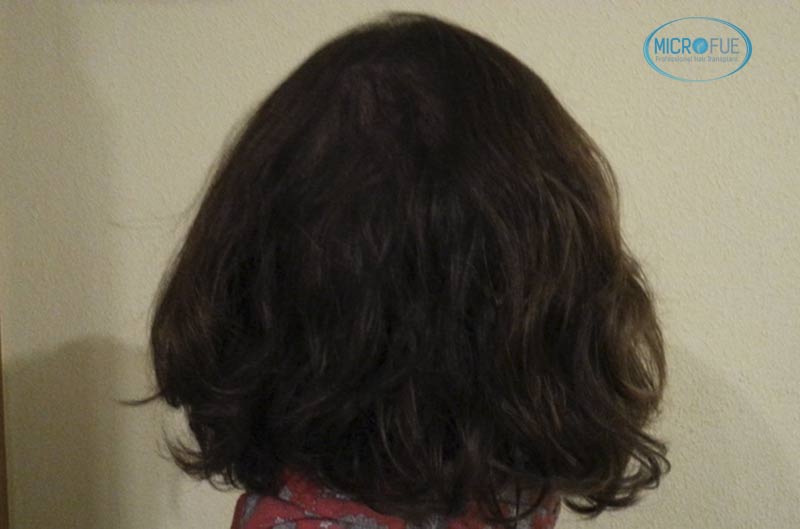trasplante_capilar_femenino_tecnica_FUE_Turquia_Microfue_20 trasplante_capilar_femenino_tecnica_FUE_Turquia_Microfue_20