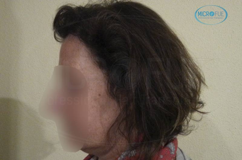 trasplante_capilar_femenino_tecnica_FUE_Turquia_Microfue_21 trasplante_capilar_femenino_tecnica_FUE_Turquia_Microfue_21