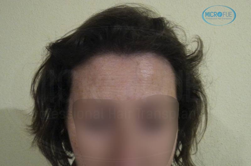 trasplante_capilar_femenino_tecnica_FUE_Turquia_Microfue_22 trasplante_capilar_femenino_tecnica_FUE_Turquia_Microfue_22