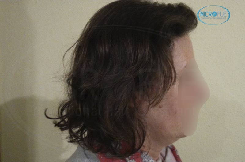 trasplante_capilar_femenino_tecnica_FUE_Turquia_Microfue_23 trasplante_capilar_femenino_tecnica_FUE_Turquia_Microfue_23