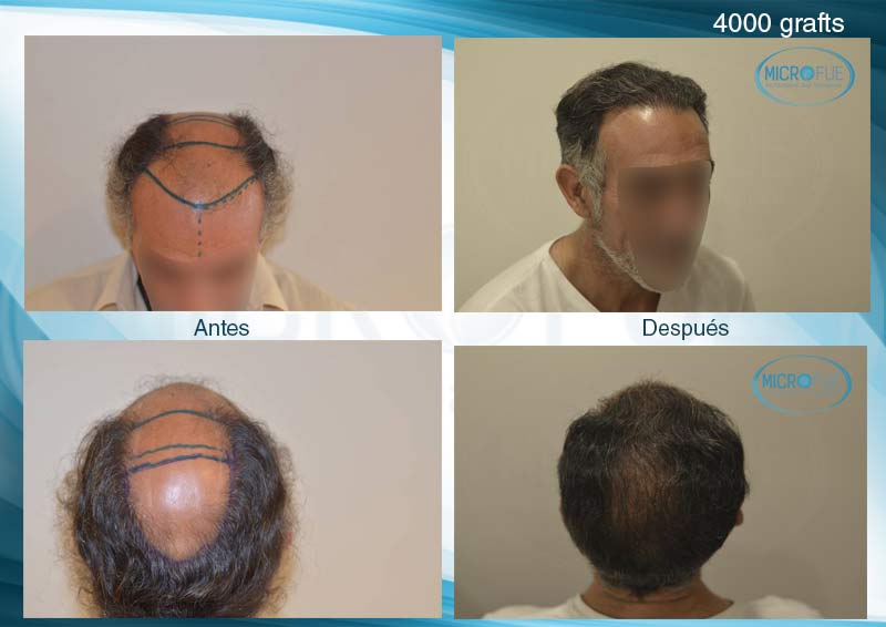 trasplante_de_pelo_Turquia_tecnica_FUE_microfue_0 trasplante_de_pelo_Turquia_tecnica_FUE_microfue_0