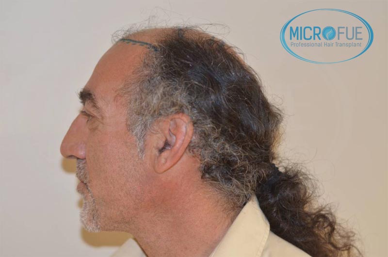 trasplante_de_pelo_Turquia_tecnica_FUE_microfue_04 trasplante_de_pelo_Turquia_tecnica_FUE_microfue_04