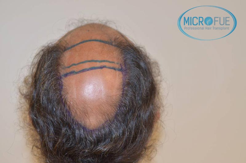 trasplante_de_pelo_Turquia_tecnica_FUE_microfue_05 trasplante_de_pelo_Turquia_tecnica_FUE_microfue_05