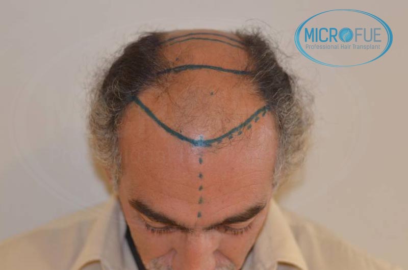 trasplante_de_pelo_Turquia_tecnica_FUE_microfue_09 trasplante_de_pelo_Turquia_tecnica_FUE_microfue_09