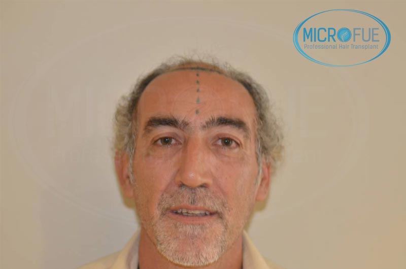 trasplante_de_pelo_Turquia_tecnica_FUE_microfue_10 trasplante_de_pelo_Turquia_tecnica_FUE_microfue_10