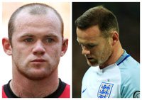 wayne_rooney_trasplante_capilar_microfue_