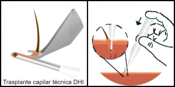 trasplante_capilar_DHI_Turquia_Microfue