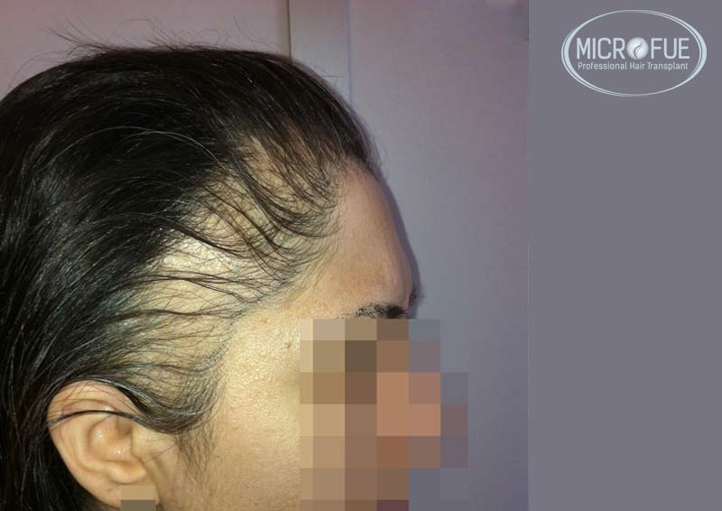 trasplante_capilar_femenino_Turquia_Microfue_00 trasplante_capilar_femenino_Turquia_Microfue_00