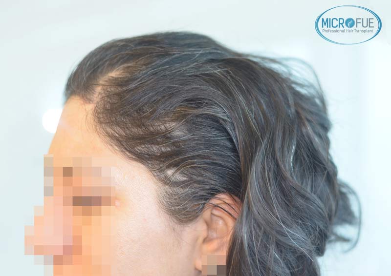 trasplante_capilar_femenino_Turquia_Microfue_01 trasplante_capilar_femenino_Turquia_Microfue_01