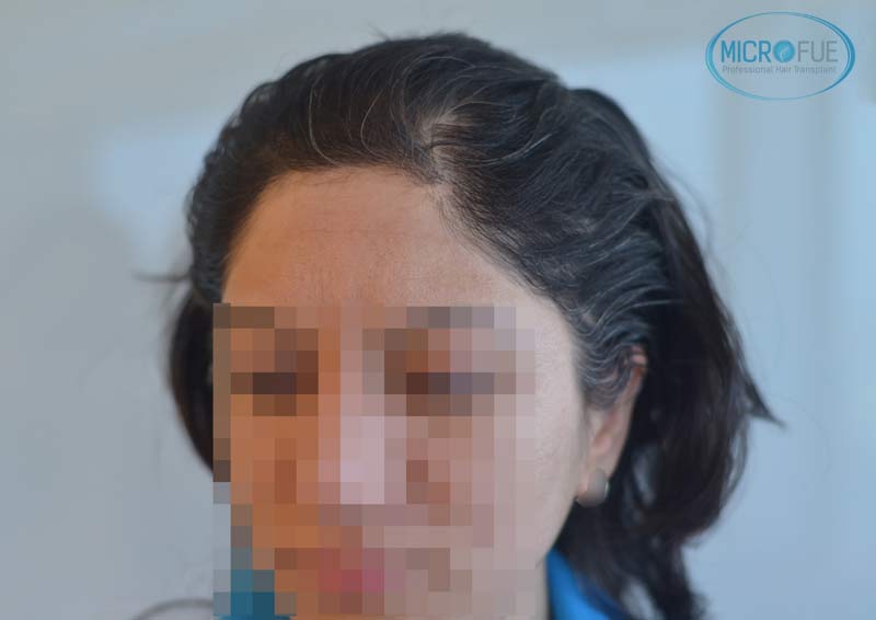 trasplante_capilar_femenino_Turquia_Microfue_02 trasplante_capilar_femenino_Turquia_Microfue_02