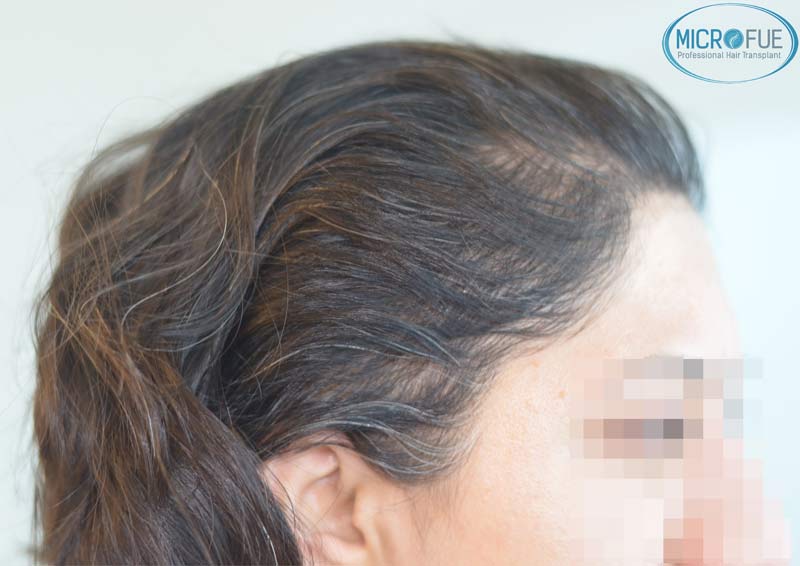 trasplante_capilar_femenino_Turquia_Microfue_03 trasplante_capilar_femenino_Turquia_Microfue_03