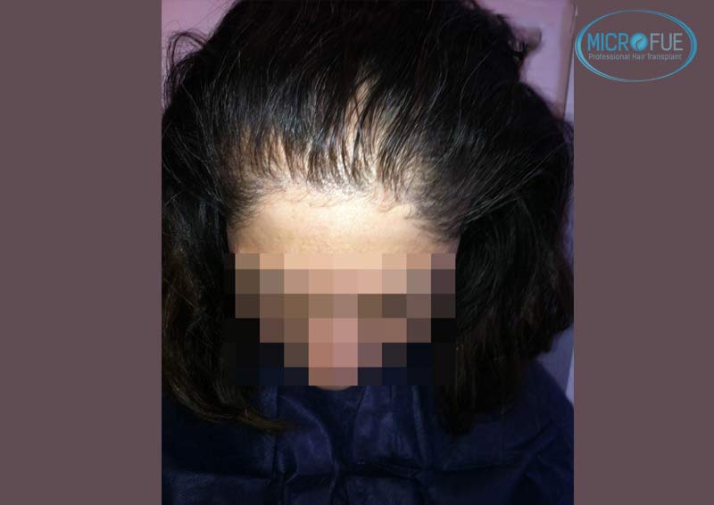 trasplante_capilar_femenino_Turquia_Microfue_07 trasplante_capilar_femenino_Turquia_Microfue_07