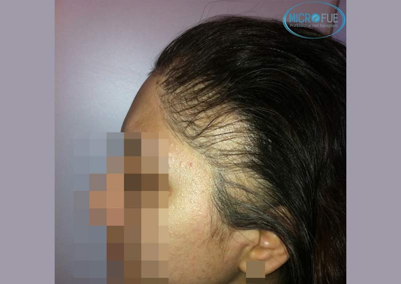 trasplante_capilar_femenino_Turquia_Microfue_12 trasplante_capilar_femenino_Turquia_Microfue_12
