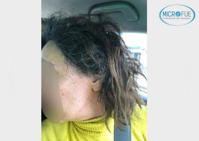 trasplante_capilar_femenino_injerto_pelo_mujer_Turquia_Microfue trasplante_capilar_femenino_injerto_pelo_mujer_Turquia_Microfue