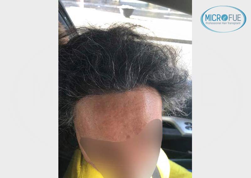 trasplante_capilar_femenino_injerto_pelo_mujer_Turquia_Microfue_2 trasplante_capilar_femenino_injerto_pelo_mujer_Turquia_Microfue_2
