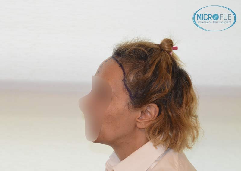 trasplante_capilar_femenino_injerto_pelo_mujer_Turquia_Microfue_9 trasplante_capilar_femenino_injerto_pelo_mujer_Turquia_Microfue_9