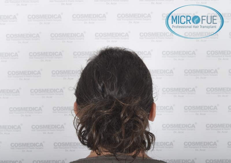 trasplante_capilar_mujer_Turquia_Microfue-07 trasplante_capilar_mujer_Turquia_Microfue-07