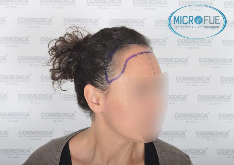 trasplante_capilar_mujer_Turquia_Microfue-08 trasplante_capilar_mujer_Turquia_Microfue-08