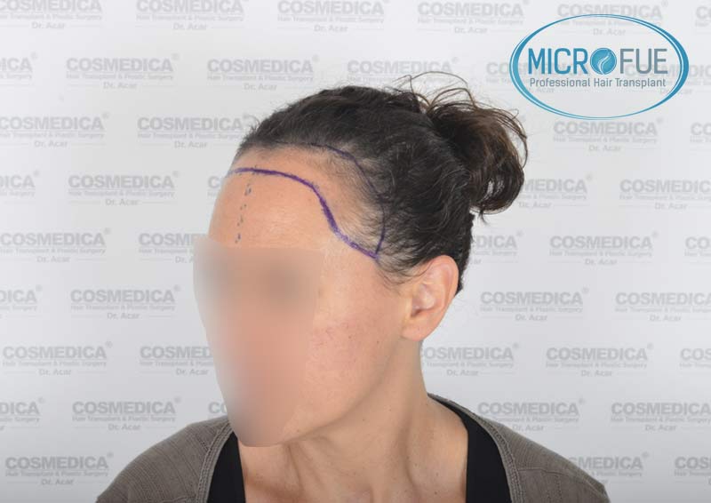 trasplante_capilar_mujer_Turquia_Microfue-09 trasplante_capilar_mujer_Turquia_Microfue-09