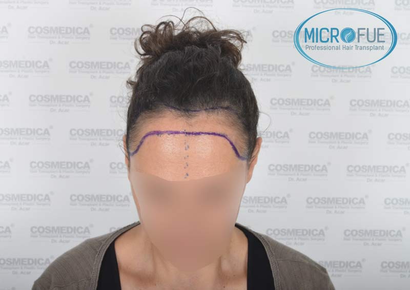 trasplante_capilar_mujer_Turquia_Microfue-10 trasplante_capilar_mujer_Turquia_Microfue-10