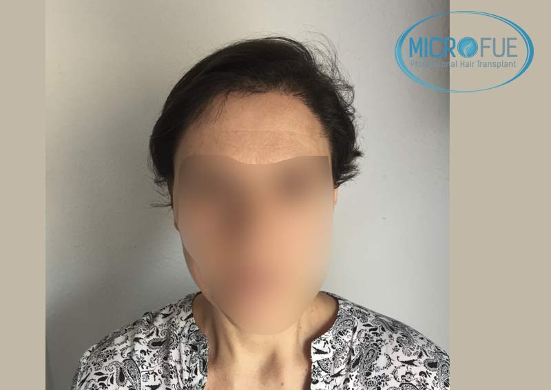 trasplante_capilar_mujer_Turquia_Microfue-12 trasplante_capilar_mujer_Turquia_Microfue-12