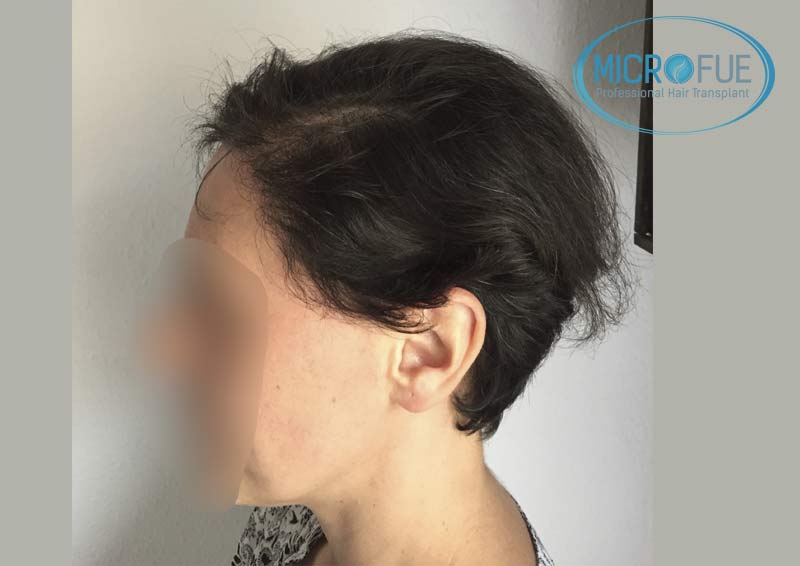 trasplante_capilar_mujer_Turquia_Microfue-13 trasplante_capilar_mujer_Turquia_Microfue-13