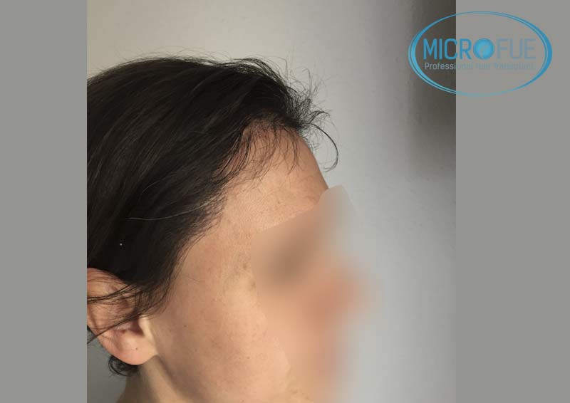 trasplante_capilar_mujer_Turquia_Microfue-14 trasplante_capilar_mujer_Turquia_Microfue-14