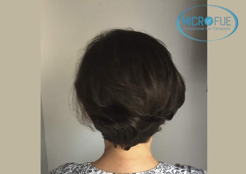 trasplante_capilar_mujer_Turquia_Microfue-16 trasplante_capilar_mujer_Turquia_Microfue-16
