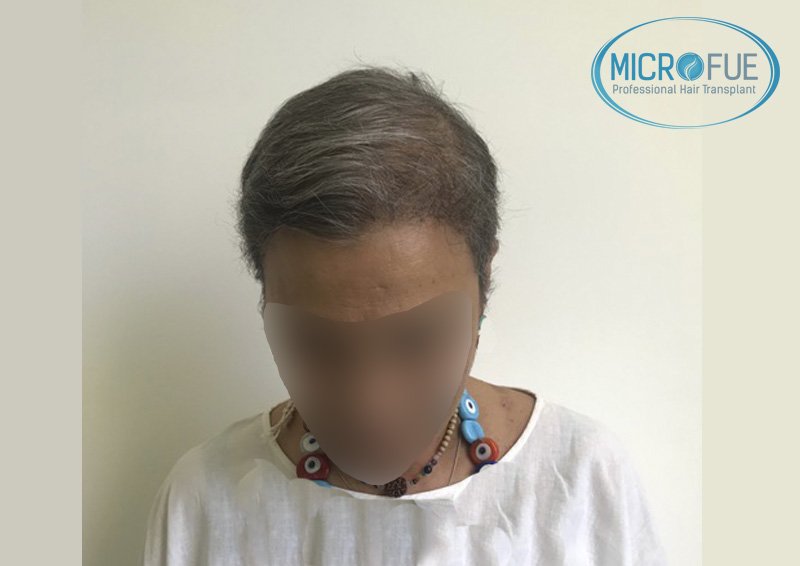 trasplante_de_pelo_microfue_Turquia_4 trasplante_de_pelo_microfue_Turquia_4