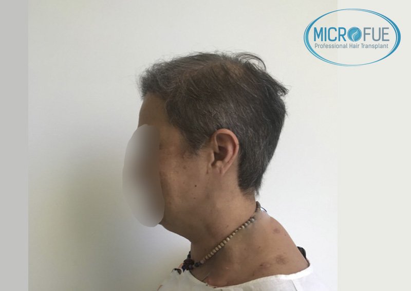 trasplante_de_pelo_mujer_Turquia_Microfue trasplante_de_pelo_mujer_Turquia_Microfue